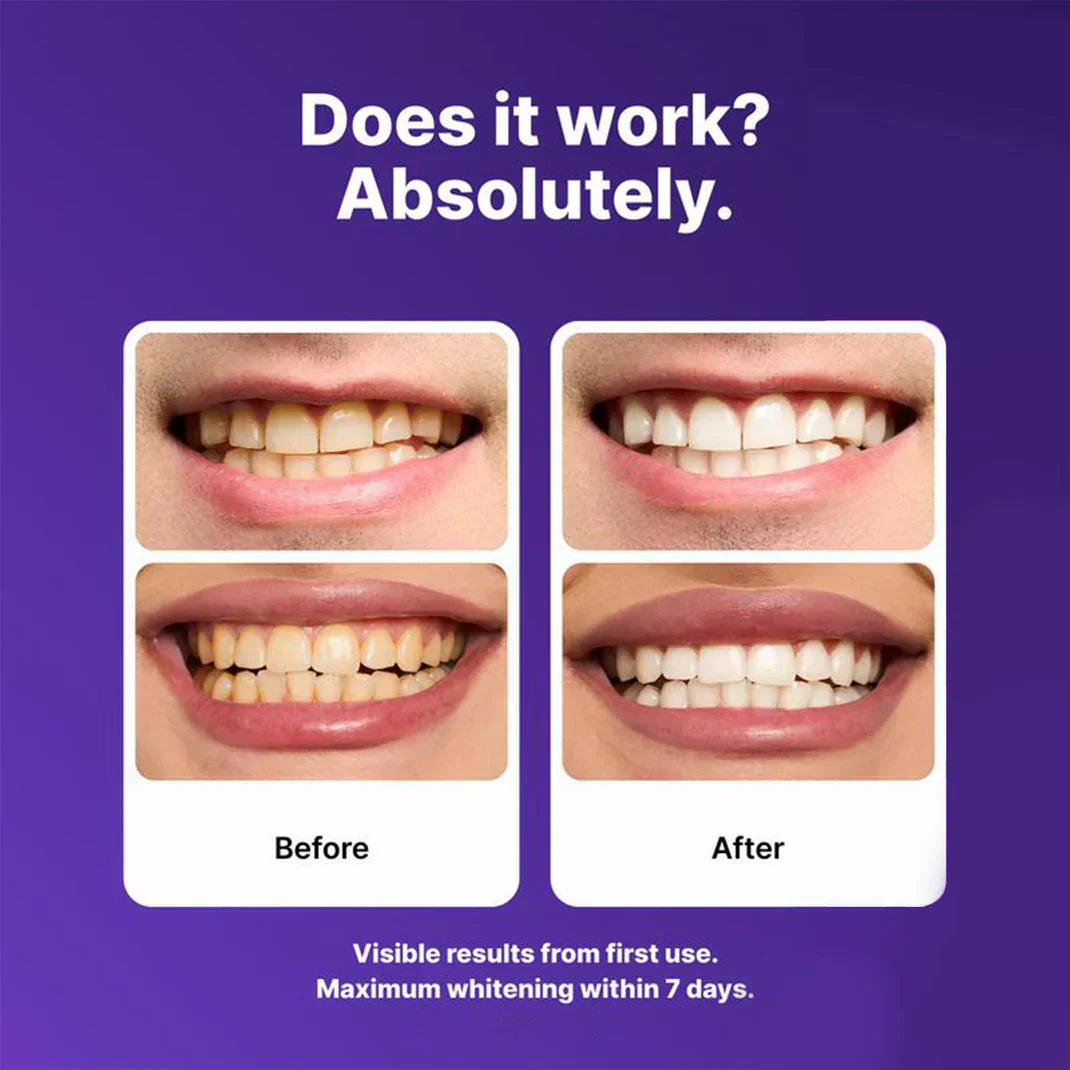 ✨Limited-Time 70% OFF Sale💜Purple Teeth Whitening Strips - Safe for Enamel