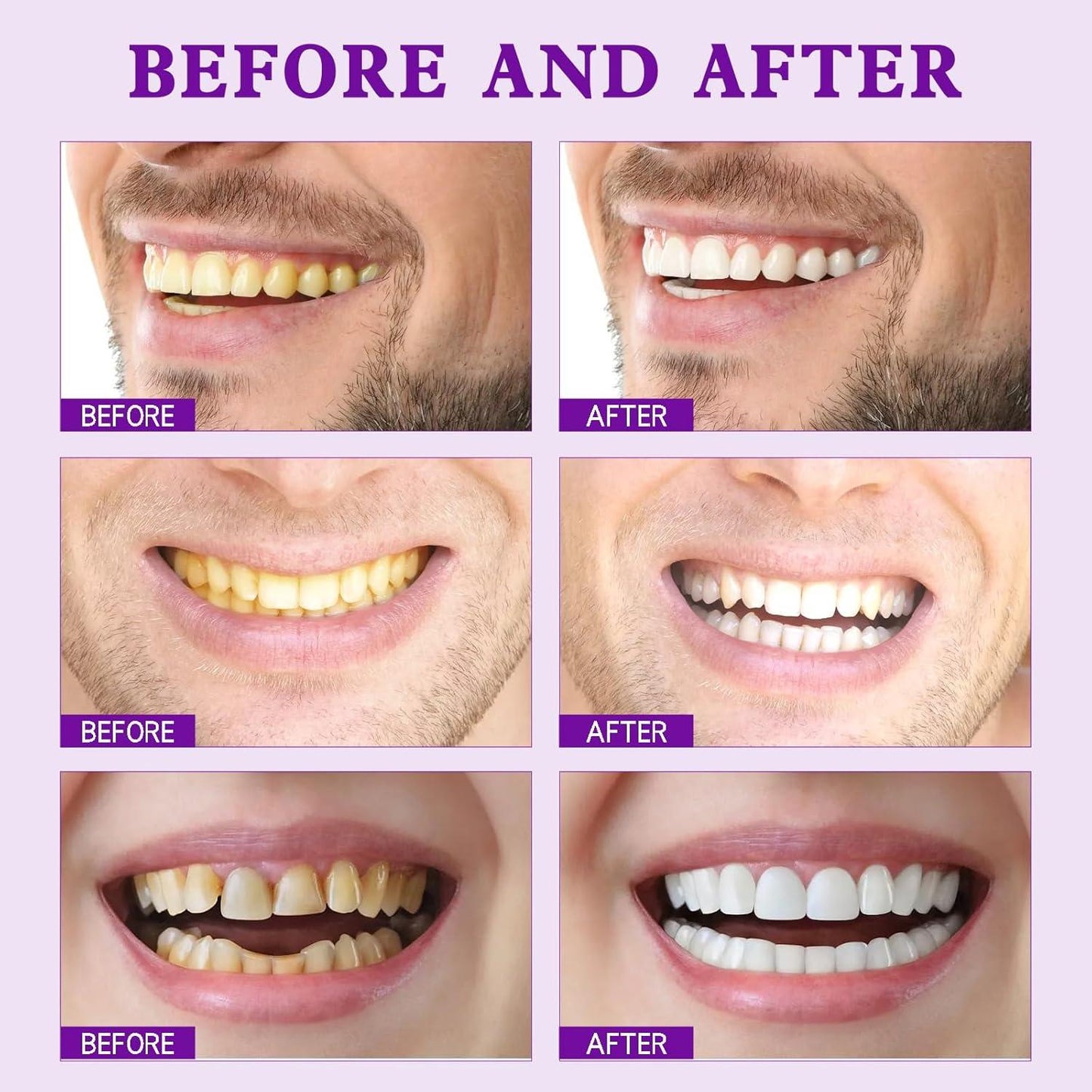 ✨Limited-Time 70% OFF Sale💜Purple Teeth Whitening Strips - Safe for Enamel