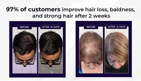 🌿AKTION ZUM LETZTEN TAG – 50 % RABATT🌿 HZA™ Natürliches Haarwuchsspray